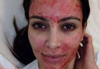 Dona de salão é presa após clientes se infectarem com HIV durante 'lifting de vampiro'