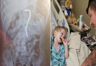 Criança de 2 anos passa por cirurgia após engolir 16 ímãs