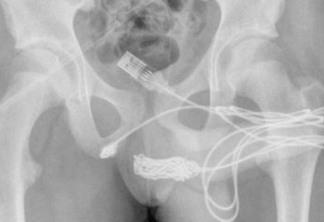 Adolescente passa por cirurgia após inserir cabo USB nas partes íntimas a fim de medir o órgão