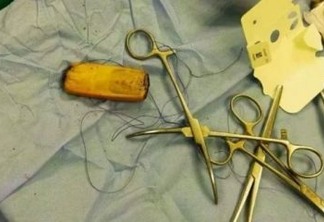 Homem faz cirurgia após passar seis meses com celular no estômago
