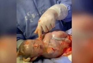 Vídeo de médico rompendo bolsa de bebê que nasceu empelicado viraliza
