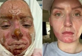Mulher mostra a recuperação após ser atingida no rosto por explosão em bar