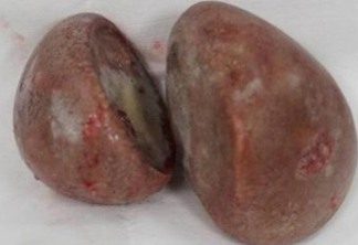 Em caso raríssimo, médicos descobrem pedras 'gigantes' na vagina de paciente