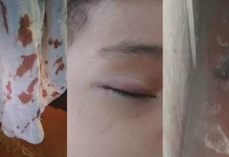 Criança fica ferida no rosto após ser atacada por rato enquanto dormia e mãe desabafa: "Pensei que ia perder a visão"