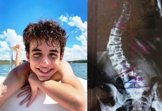 Família faz campanha para pagar cirurgia de R$ 250 mil para adolescente com 'coluna em S'