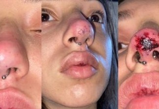 Jovem fica com o nariz necrosado após procedimento estético