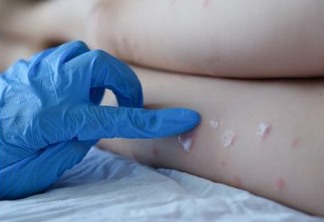 Ministério da Saúde confirma terceiro caso de varíola dos macacos