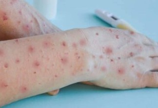 Cientistas alertam para novos sintomas da varíola dos macacos: inchaço das partes intimas
