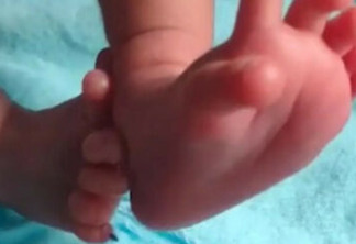 Menina nasce com 26 dedos e família considera como um "presente divino"; entenda
