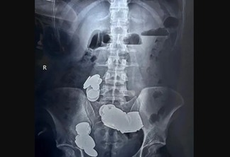 Médicos retiram 39 moedas e 37 ímãs do intestino de fisiculturista que os engoliu para ‘absorver zinco’