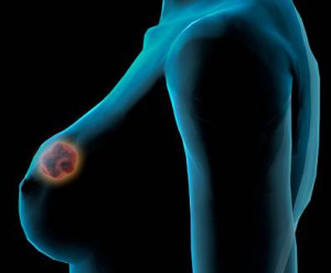 mama 3 300x248 - Câncer de mama: biossensor desenvolvido em Pernambuco ganha prêmio nos Estados Unidos