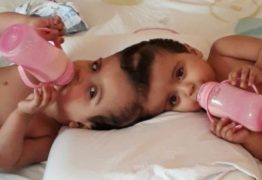 Gêmeas siamesas passam por 3ª cirurgia de separação