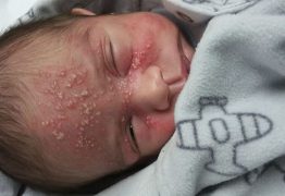 Bebê contrai herpes em beijo de visita e mãe faz o alerta nas redes sociais