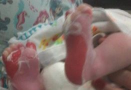 Recém-nascido que sofreu queimaduras nos pés segue internado no Trauma de JP