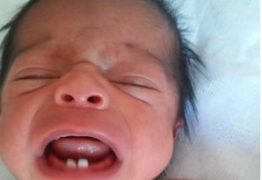 UMA A CADA 2 MIL: bebê nasce com dois dentes