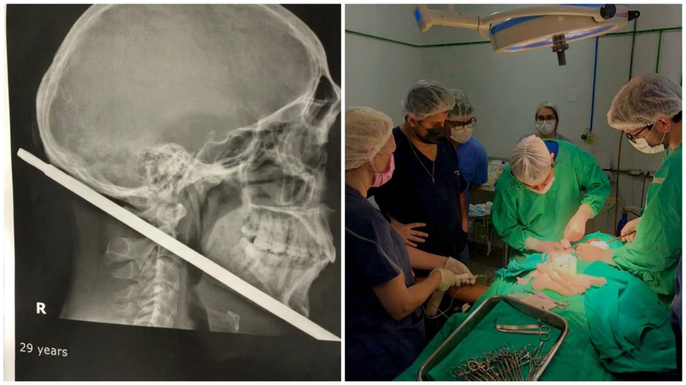 imagem e cirurgia - NOVA VIDA! Paciente passa por cirurgia para retirar ferro que atravessou a lateral do pescoço: 'Eu sou um milagre'