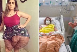 Em cirurgia inédita no Brasil, jovem retira mais de 30kg de tumores do corpo