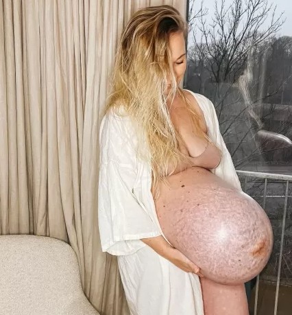 gravidez - Grávida de trigêmeos, influencer chama atenção na web após postar foto da barriga; médica explica situação