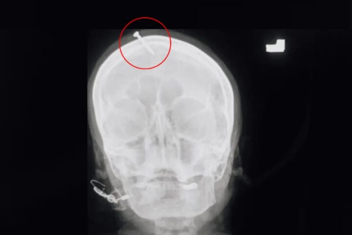 BeFunky collage 90 720x480 1 - DICA DE UM CURANDEIRO: Grávida martela prego na cabeça para dar à luz a um menino 