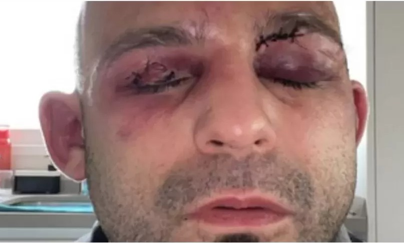 Capturar 67 - DESFIGURADO: Lutador mostra como ficou seu rosto após perder luta do título mundial