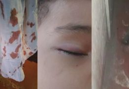 Criança fica ferida no rosto após ser atacada por rato enquanto dormia e mãe desabafa: “Pensei que ia perder a visão”