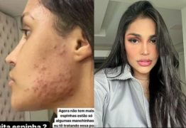 “Destruiu minha pele”: Paraibana Flay expõe efeito colateral do ‘chip da beleza’ 