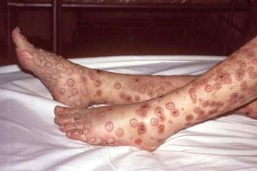 f960x540 81710 155785 0 360x240 - VARÍOLA DO MACACO: rara infecção viral está se espalhando pelo mundo; SAIBA MAIS