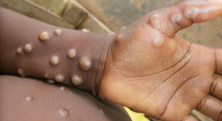variola - ALERTA! Estudo mostra que varíola dos macacos foi transmitida durante sexo em 95% dos casos