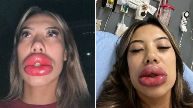 blog lips - Mulher tem forte reação alérgica após preenchimento labial e acaba na emergência de hospital