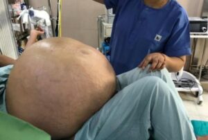 0000 300x202 - Mulher passa por cirurgia para remover tumor de 70 quilos no abdômen