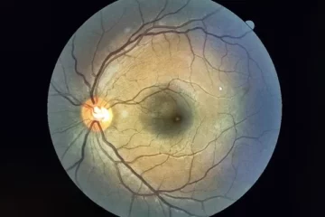ALERTA: Oftalmologista atende paciente com lesão na retina após olhar para o eclipse solar sem proteção; veja os sintomas