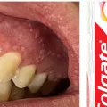 ALERTA: Anvisa volta a proibir venda de pasta de dente da Colgate