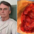 Bolsonaro choca internautas ao publicar imagem de intestino durante cirurgia; veja foto