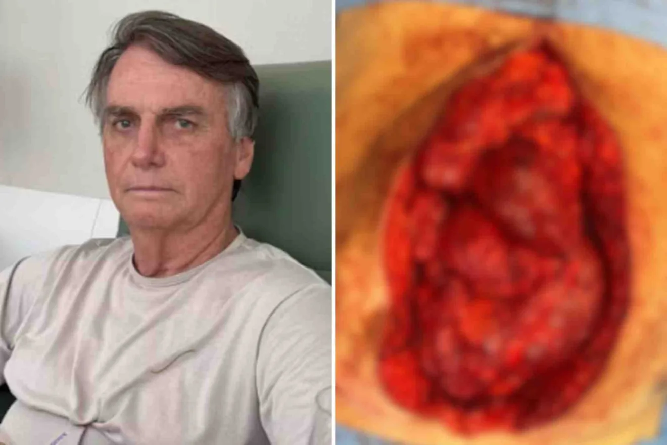 Bolsonaro choca internautas ao publicar imagem de intestino durante cirurgia; veja foto Bolsonaro choca internautas ao publicar imagem de intestino durante cirurgia; veja foto
