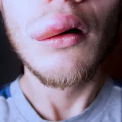 Mais de 1,2 mil pessoas relatam reações adversas ao creme dental Colgate
