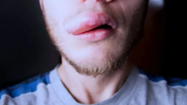 Mais de 1,2 mil pessoas relatam reações adversas ao creme dental Colgate