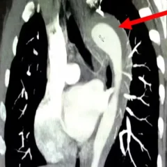 Orgasmo quase fatal: mulher rompe aorta durante relação e passa por cirurgia de urgência