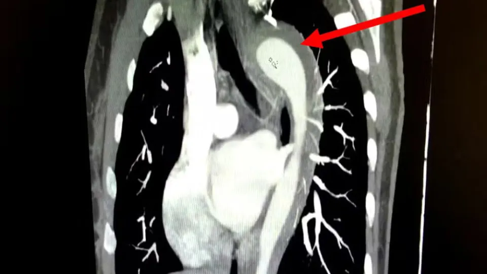 Orgasmo quase fatal: mulher rompe aorta durante relação e passa por cirurgia de urgência